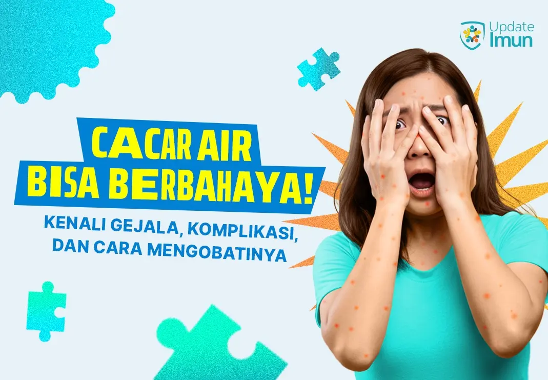 Bukan Sekedar Bintik Merah, Cacar Air Bisa Berbahaya Jika Kamu Lengah